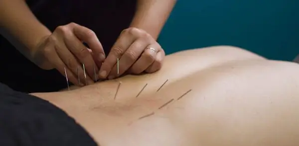 Read more about Dry Needling a Clinical Approach to Treating Soft Tissue Injuries